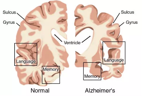 AD药物研发现状：辉瑞、礼来、百健、诺华、强生……
