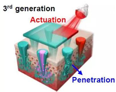 第三代：通过微针介导的皮肤层破坏和微针伴随的各种功能增强药物转运.jpg