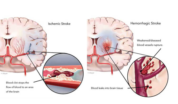 世界卒中日：从动物药效模型评价看心脑血管药物开发
